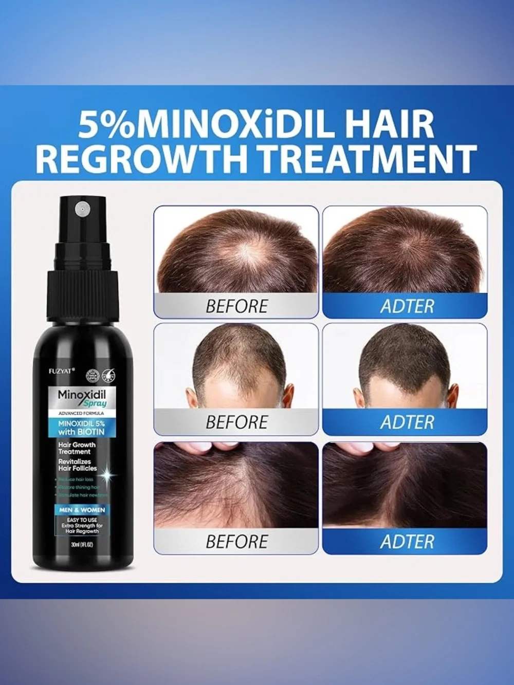 FUZYAT Minoxidil Spray 5% with Biotin